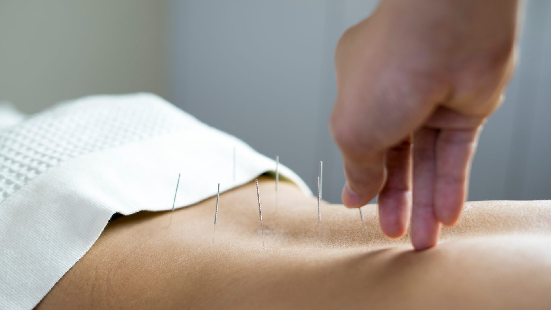 Acupuncture